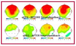 Neurofeedback