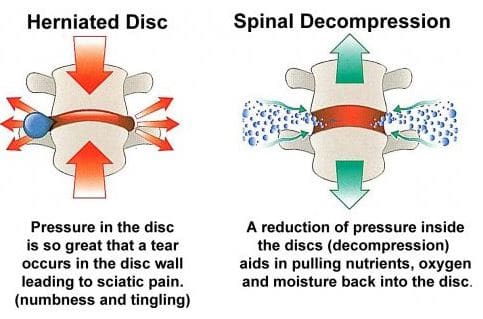 Spinal Decompression