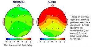 Chiropractic West Greenwich RI Brain Map Patterns