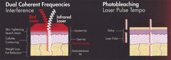 Chiropractic West Greenwich RI Dual Coherent Frequencies & Photobleaching