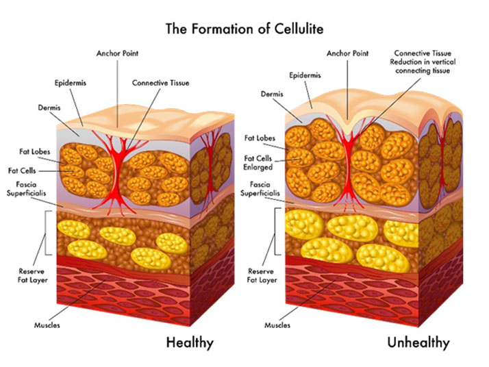 Chiropractic West Greenwich RI Formation Of Cellulite