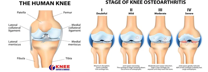 Chiropractic West Greenwich knee centers of america graphic